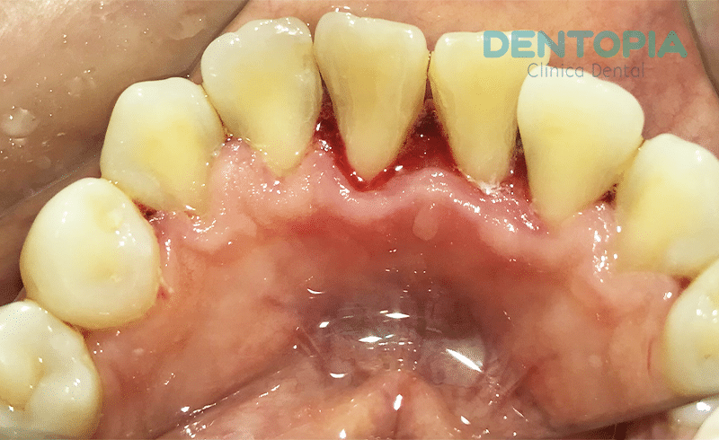 Importancia de la limpieza dental cada 6 meses